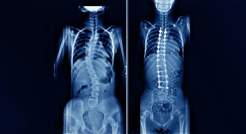 What You Need to Know About Scoliosis: Causes, Symptoms,Management