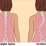 how do i know if i have scoliosis