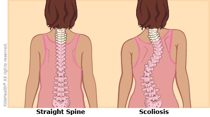 how do i know if i have scoliosis