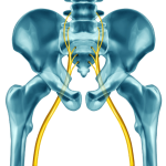 can scoliosis cause sciatica